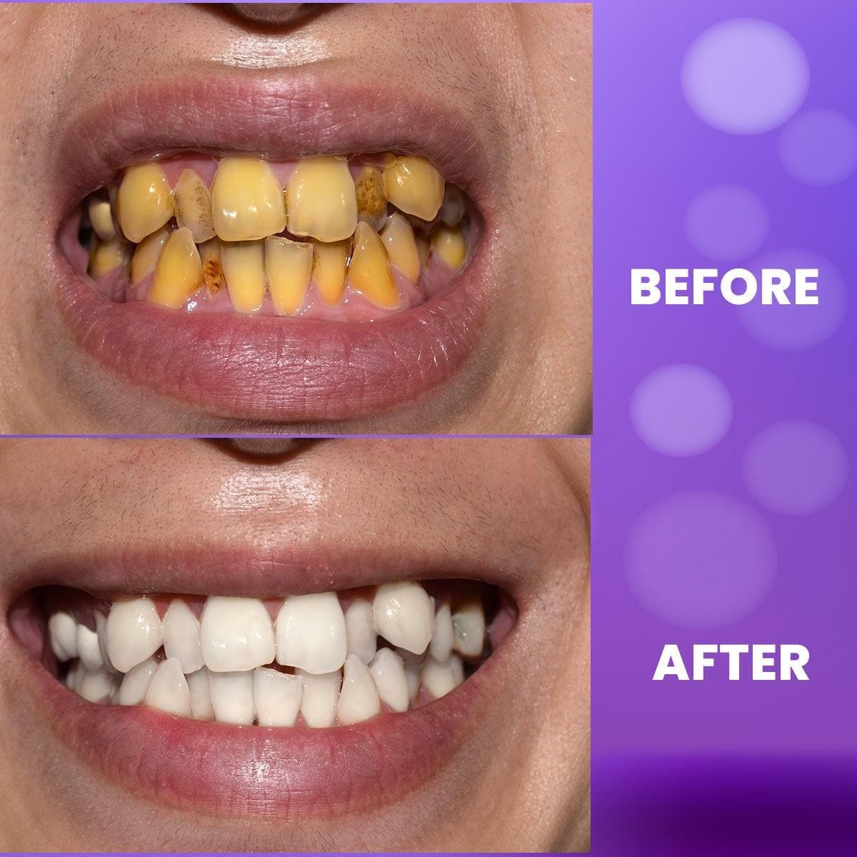 BloomBright™ Purple Teeth Whitening Gel